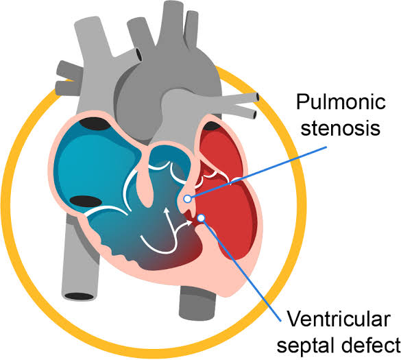 Congenital heart disease - health