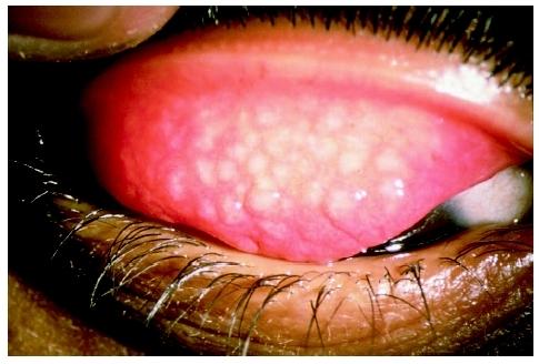 Trachoma