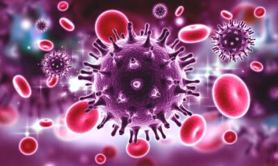 HIV and AIDS