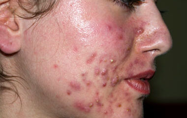 Acne cosmetic skin condition