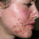 Acne cosmetic skin condition