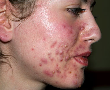 Acne cosmetic skin condition