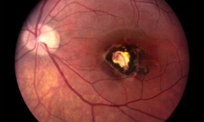 Toxoplasmosis disease virus