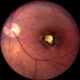 Toxoplasmosis disease virus
