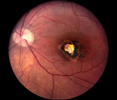 Toxoplasmosis disease virus